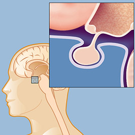 پرولاکتینوما | علائم، علل، آزمایش ها و درمان افزایش هورمون پرولاکتین